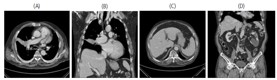 The chest computed tomography(CT) on November 2014 showed about 3.1cm sized lung mass in right middle lobe(RML) with lymph nodes metastases(A, B). The abdomen computed tomography(CT) on November 2014 showed the well-defined ovoid shaped right adrenal mass which may be either adenoma or metastasis(C), the renal cysts and no ascites(D).
