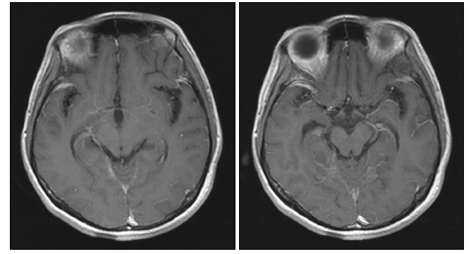 Brain MRI T1-weighted image at 30 days after onset.