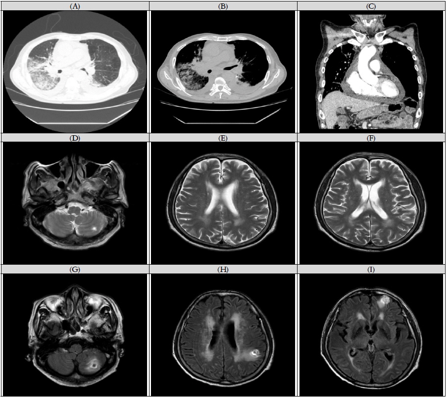 The chest CT showed infectious pneumonia(A), lung cancer with both pleural effusion(B) and pericardial effusion(C) on May, 2014. The brain MRI on February, 2014 showed improved status of brain metastasis at cerebellar hemisphere(D), parietotemporal lobe(E), frontal lobe(F) after WBRT. But after delirium event at our hospital, the brain MRI on June, 2014 showed progressive status of brain metastasis at cerebellar hemisphere(G), parietotemporal lobe(H), frontal lobe(I).