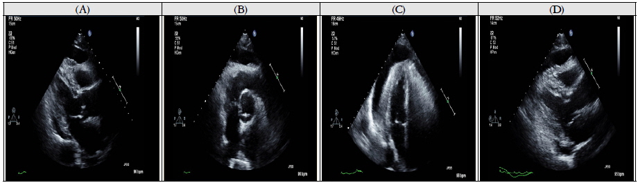 The echocardiography showed large amount of pericardial effusion with earlyy tamponade physiology(A), (B), (C), (D) on June, 2014.