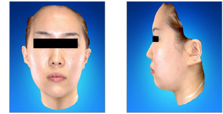 Anterior view and lateral view of face scanned by 3D Facial Scanner (RFS-S100) (May-21-2013)