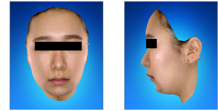 Anterior view and lateral view of face scanned by 3D Facial Scanner (RFS-S100) (Nov-14-2013)