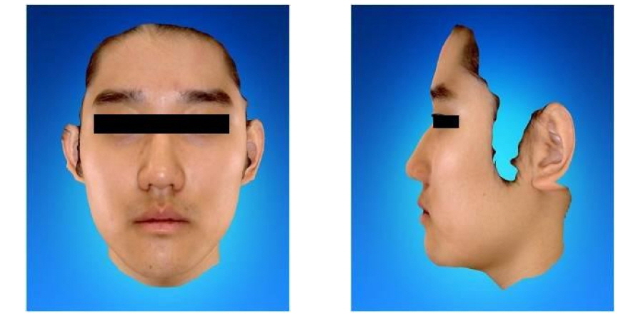 Anterior view and lateral view of face scanned by 3D Facial Scanner (RFS-S100) (Oct-15-2012)