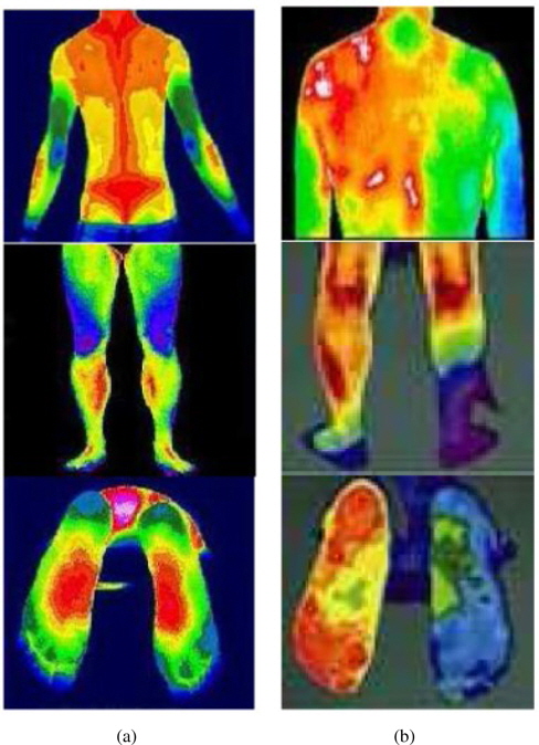 Comparison of (a) healthy and (b) unhealthy subjects by digital infrared thermal imaging.