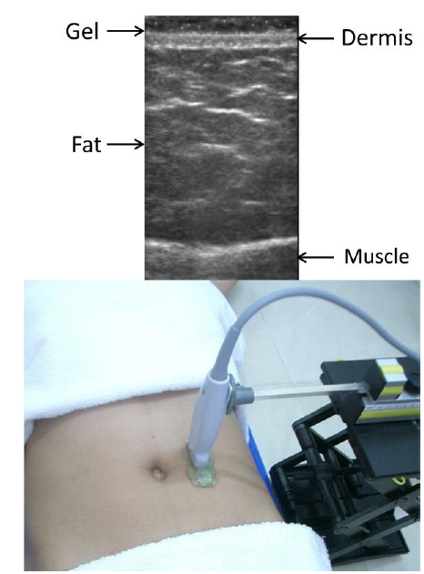 Compression-free sonographic measurement: B-mode ultrasound transducer was held statically 4 cm lateral to umbilicus and floated at the top of abdominal skin.