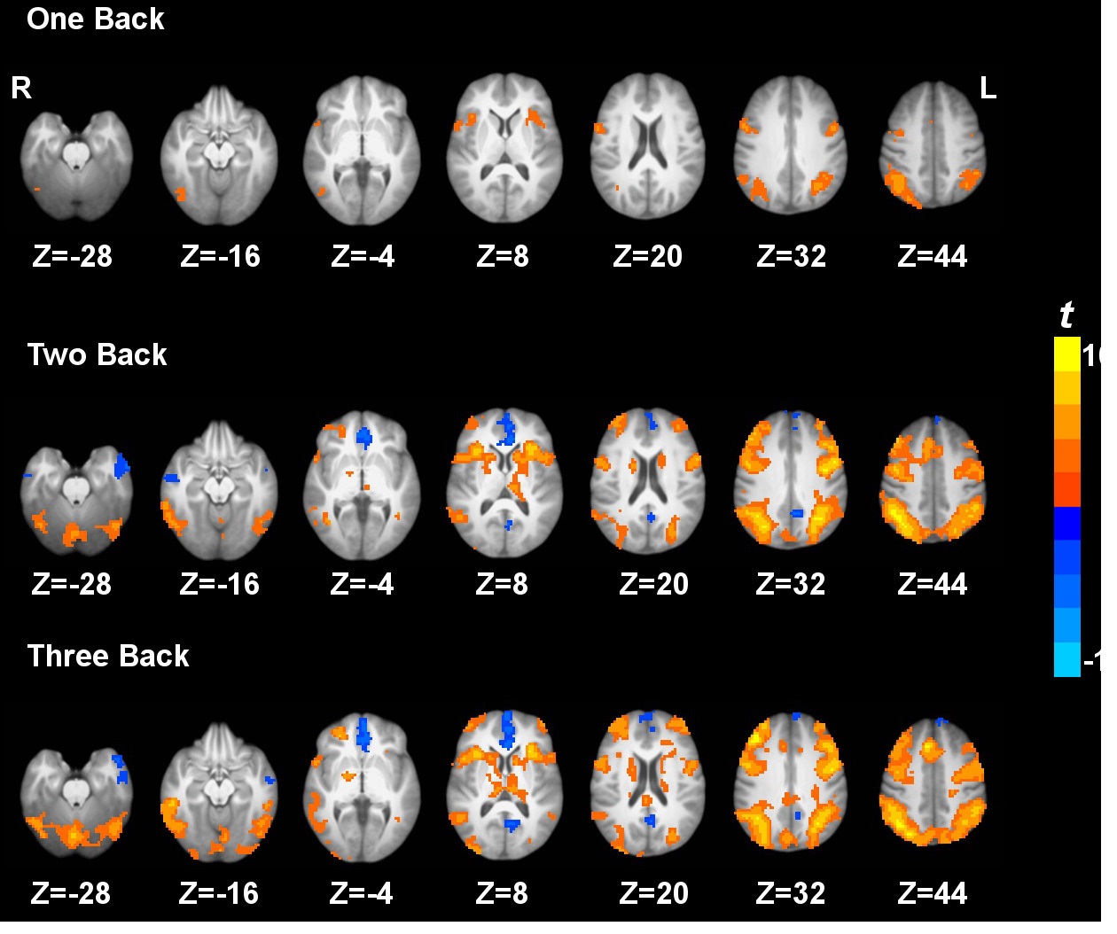 Paired t-maps between the three active working memory task conditions and the 0 back baseline vigilance task condition based on quantified CBF. p < 0.05 corrected. ‘L’ denotes the left hemisphere of the brain and ‘R’ denotes the right hemisphere.