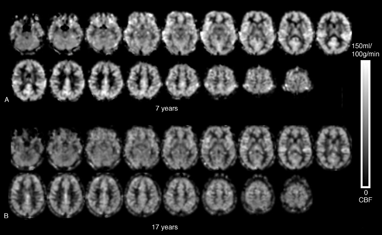 ASL CBF Images (A) 7 year-old (global CBF = 70.7 ml/100g/min) and (B) 17 year-old (global CBF = 56.5 ml/100g/min). Visually there is relative perfusion decrease in bilateral pericentral gyri (primary sensory and motor cortices), bilateral anterior and dorsolateral frontal lobes, and the cingulated cortex, particularly in the posterior portion.