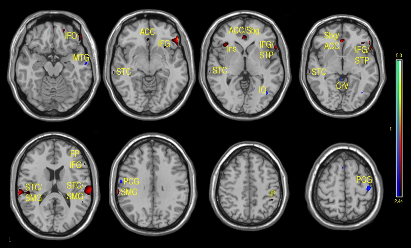 Regions of positive or negative correlation between FSIQ and CBF in children and adolescents 7-17 years of age. Positive (red-yellow): bilateral anterior cingulate cortex (ACC), subgenual (Sbg), right inferior frontal orbital (IFO), right inferior frontal gyrus (IFG), frontal pole (FP), left insula (Ins), bilateral supramarginal gyrus (SMG), postcentral cortex (PtC) and superior temporal pole (STP). Negative (aqua-blue): right mid temporal gyrus (MTG), inferior occipital (IO), bilateral cerebellar vermis (Cv), medial and superior precentral gyrus (PCG) (p-value = .01 with minimum cluster size of 50 pixels).