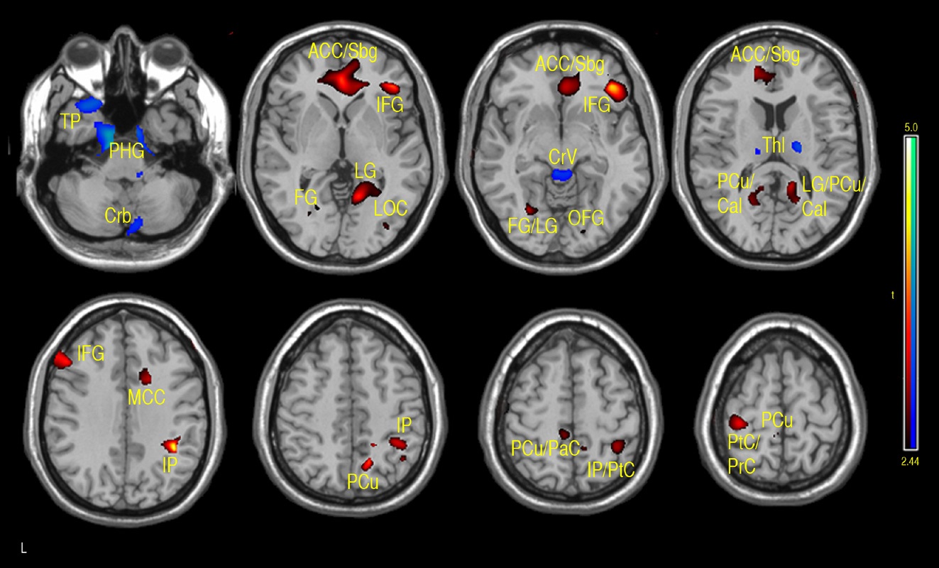 Regions of positive or negative correlation between IQ and VBM in children and adolescents 7-17 years of age. Positive (red-yellow): bilateral subgenual/anterior cingulate cortex (Sbg/ACC), right frontal inferior orbital (FIO), right inferior frontal gyrus (IFG), left IFG, left fusiform gyrus (FG), precuneus (PCu), right lingual gyrus (LG), bilateral calcarine (Cal), right mid cingulum cortex (MCC), inferior parietal (IP), paracentral cortex (PaC), postcentral cortex (PtC), precentral cortex (PrC). Negative (aqua-blue): left temporal pole (TP), bilateral fusiform and parahippocampal gyrus (FU/ PHG), right cerebellum (Crb), bilateral thalamus (Thl), cerebellar vermis (Cv), (p-value = .01 with minimum cluster size of
50 pixels).