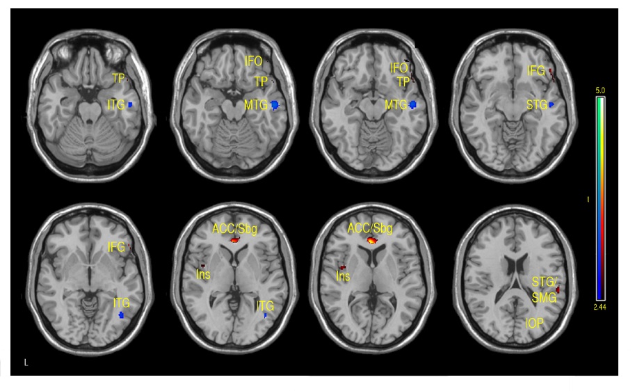 Regions of positive or negative correlation between IQ and GMD adjusted CBF in children and adolescents 7-17 years of age. Positive (redyellow): bilateral subgenual (Sbg) and anterior cingulate cortex (ACC), right inferior frontal orbital (IFO), right inferior frontal gyrus (IFG), left insula (Ins) and superior temporal gyrus (ST), supramarginal gyrus (SMG). Negative (aqua-blue): right inferior temporal gyrus (ITG), right mid temporal gyrus (MTG), right superior temporal gyrus (STG), and right inferior
occipital pole (IOP) (p-value = .01 with minimum cluster size of 50 pixels).