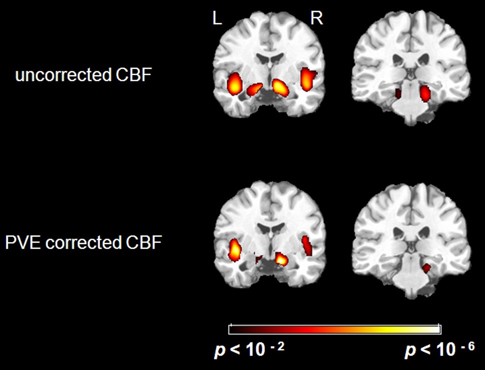 Whole brain voxel-wise results for multiple regression analysis of CBF and age. Top: Uncorrected mean CBF value and age were negatively correlated (global mean CBF and gender as covariance) in bilateral parahippocampal gyrus, right posterior parahippocampus and bilateral insula. These regions were selected as ROIs for later comparison. See Table 1 for detailed Talairach coordinates and voxel sizes. Bottom: After being corrected by PVE, CBF images and age showed a significant negative correlation (global mean CBF and gender as covariance) in almost the same locations as above, but there was no longer anya significant correlation in the left parahipocampal gyrus. See Table 2 for detailed T values.