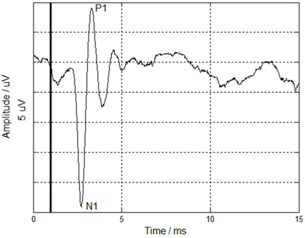 OCAPs measured in a deaf animal. The stimulation has a radiant exposure of 24.29 mJ/cm2, pulse duration of 100 μs, and repetition rate of 0.5 Hz. Each grid represents 5 μV.