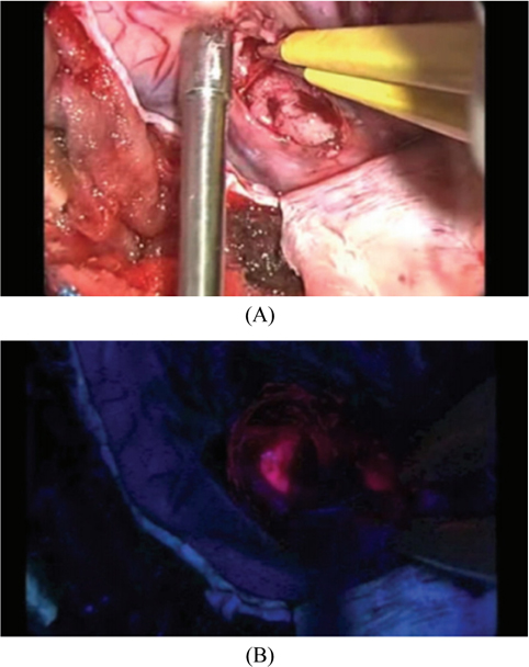 Detect the (A) original image and (B) fluorescence image of tumor using exosocope with 5-ALA [65].