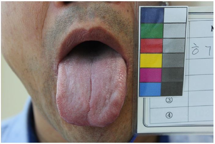 Picture of tongue for the assessment.
