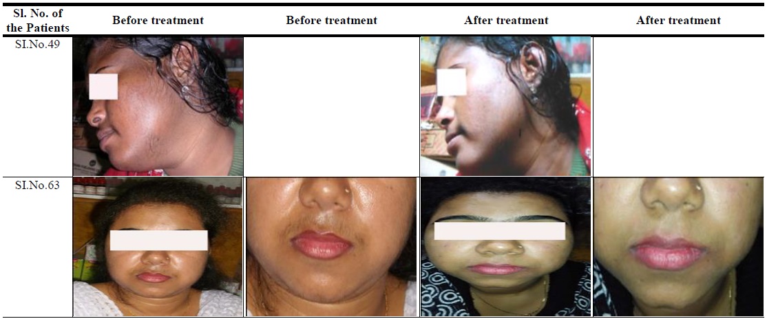 Image showing removal of hair in hirsutism patients.