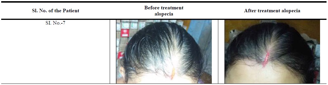 Images showing amelioration of male type alopecia.