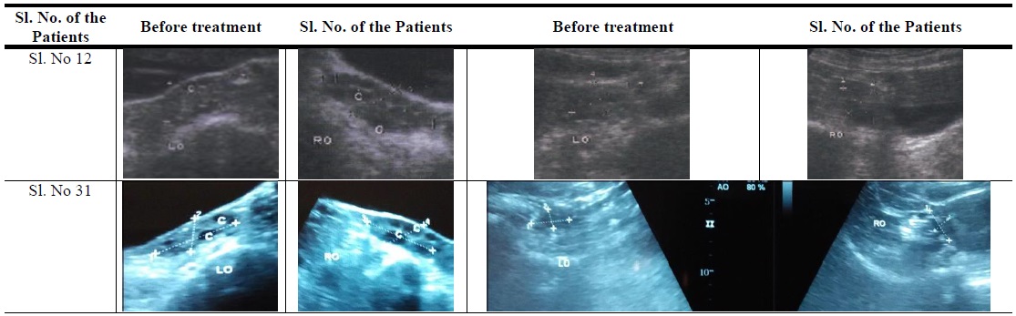 Images of Ultra sonography of the patients showing removal of cysts from ovary (left and right ovaries).