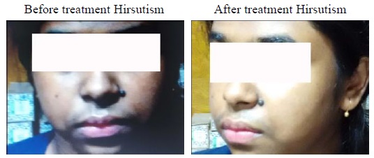 Images showing removal of hair in a hirsutism patient after drug administration.