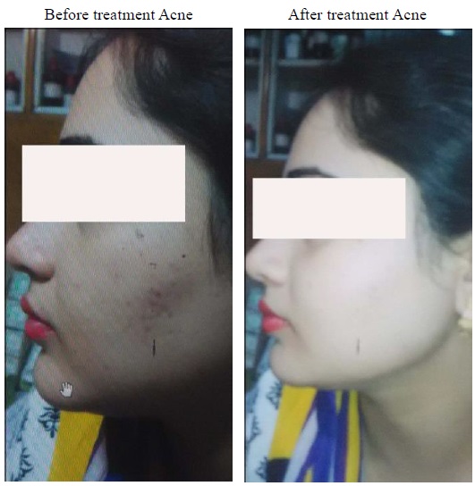 Images of patient showing removal of acne after treatment.