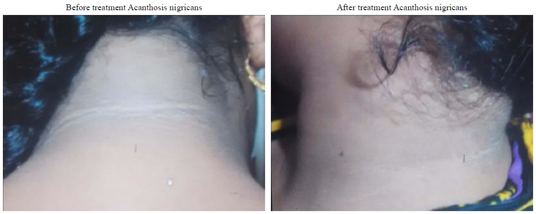 Images showing amelioration of patient with acanthosis nigricans.
