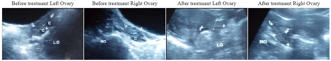 Images of Ultra-sonography of the patients showing removal of cysts from ovary (left and right ovaries)