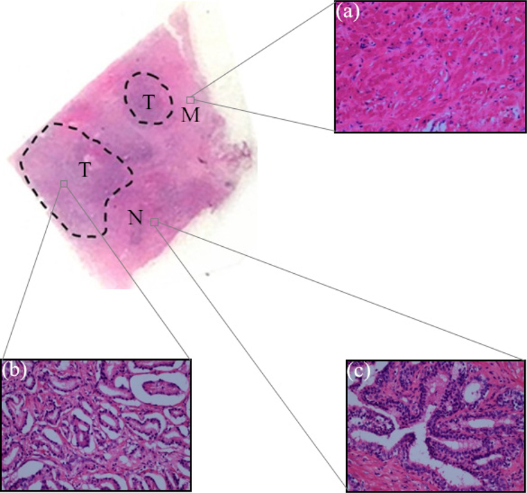 H-E staining of prostate cancerous tissue and its partial enlargement under the microscope. (a) Pathological features of smooth muscle tissue (×400); (b) Pathological features of prostate tumor (×400); (c) Pathological features of normal prostate tissue (×400).