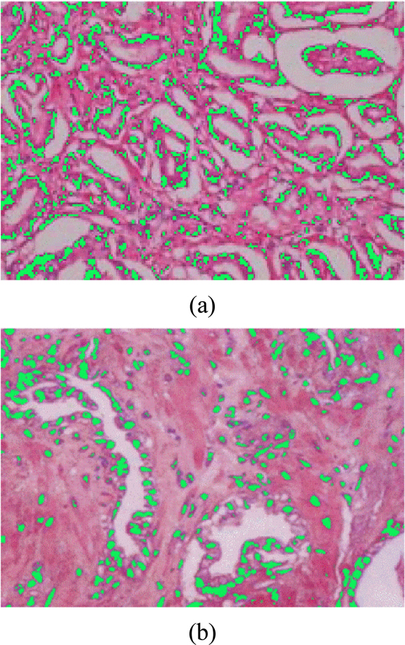 Cell nuclear recognition of H-E staining images. (a) Tumor tissues; (b) Normal tissues.