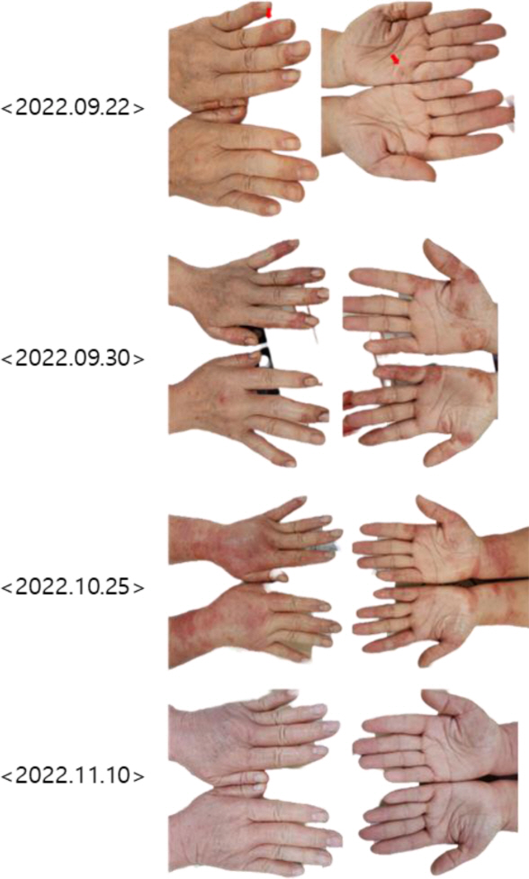 Changes in eczema over time before and after nutritional therapy