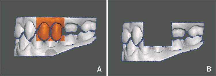 OAK 국가리포지터리 - OA 학술지 - Journal of Korean Dental Science - Accuracy of ...